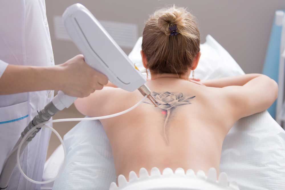 إزالة الوشم في تركيا tattoo removal 1 إزالة الوشم