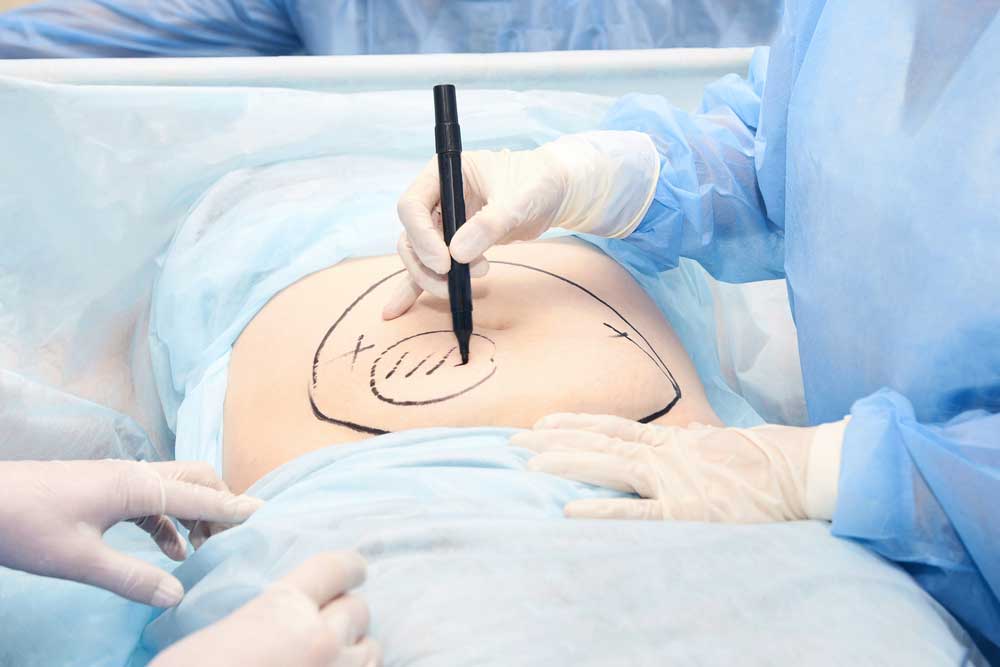 نقل الدهون 7 نصائح شفائية من أجل الحصول على أفضل النتائج 1 نقل الدهون