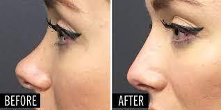 خيوط الانف لـ تجميل الأنف بطريقة غير جراحية! 1 خيوط الانف لـ تجميل الأنف بطريقة غير جراحية!