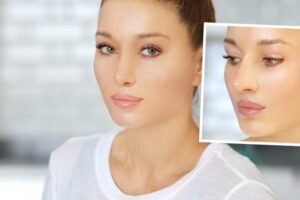 تجميل الانف بدون جراحة