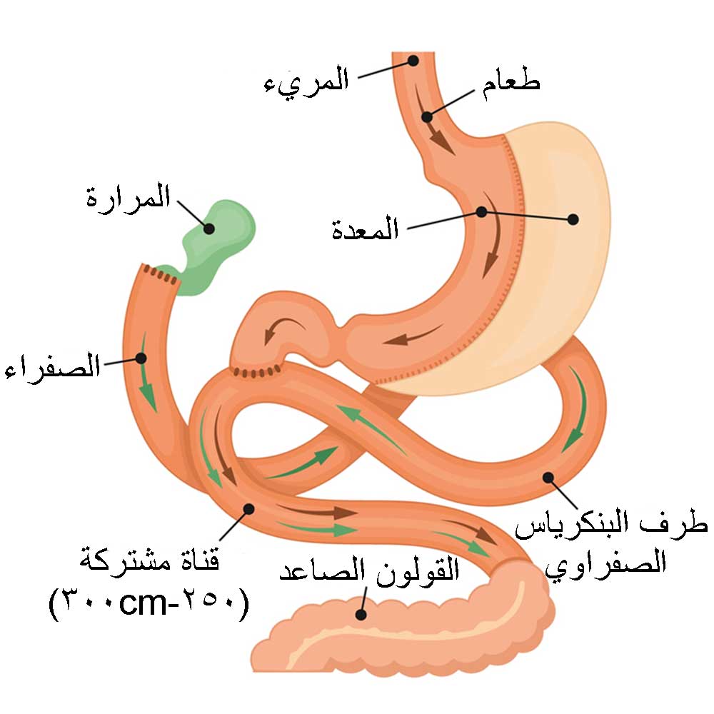 عملية الساسي في تركيا Gastrectomy SASI-S 1 عملية الساسي في تركيا