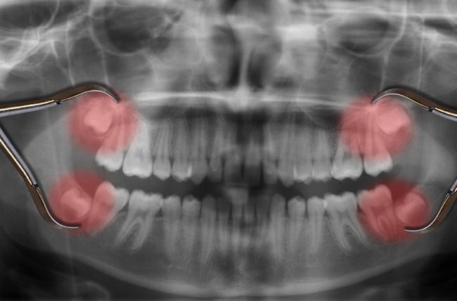 ضرس العقل و 3 علامات تسبق خلعه 1 ضرس العقل و 3 علامات تسبق خلعه