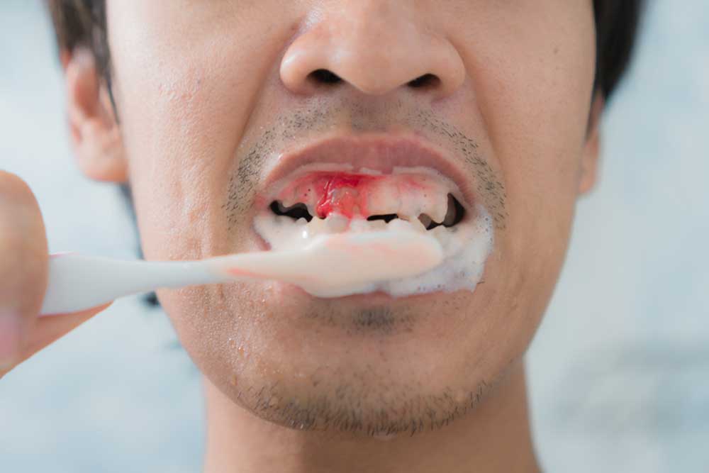 نزيف اللثة وما الذي يسببها bleeding gums 1 نزيف اللثة