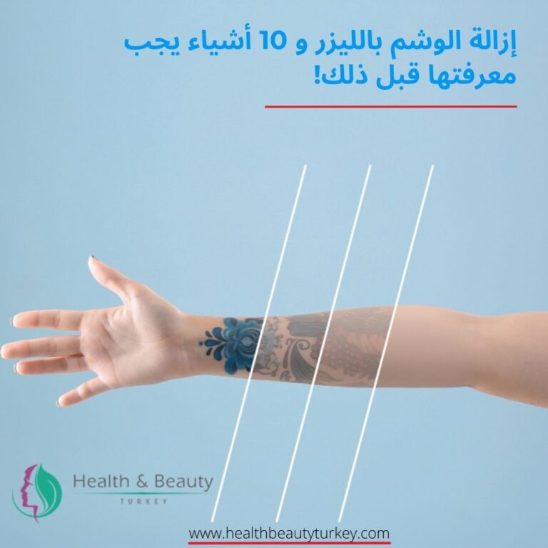 ازالة التاتو بالليزر