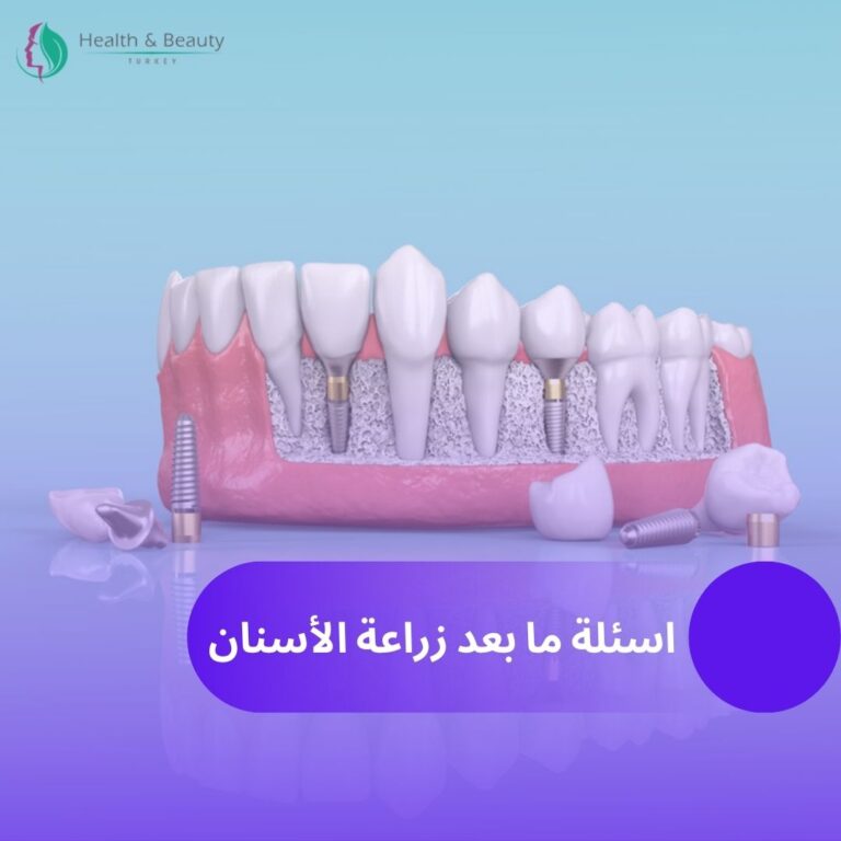 ما بعد زراعة الأسنان