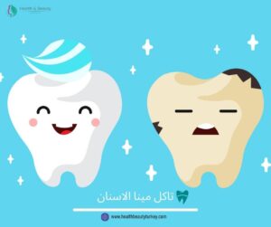 تاكل مينا الاسنان