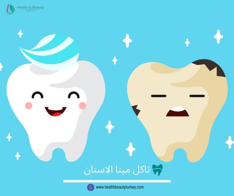 تاكل مينا الاسنان