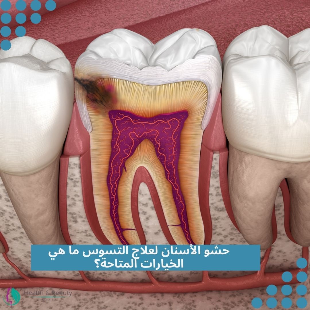 حشو الأسنان لعلاج التسوس ما هي الخيارات المتاحة؟ 1 حشو الأسنان