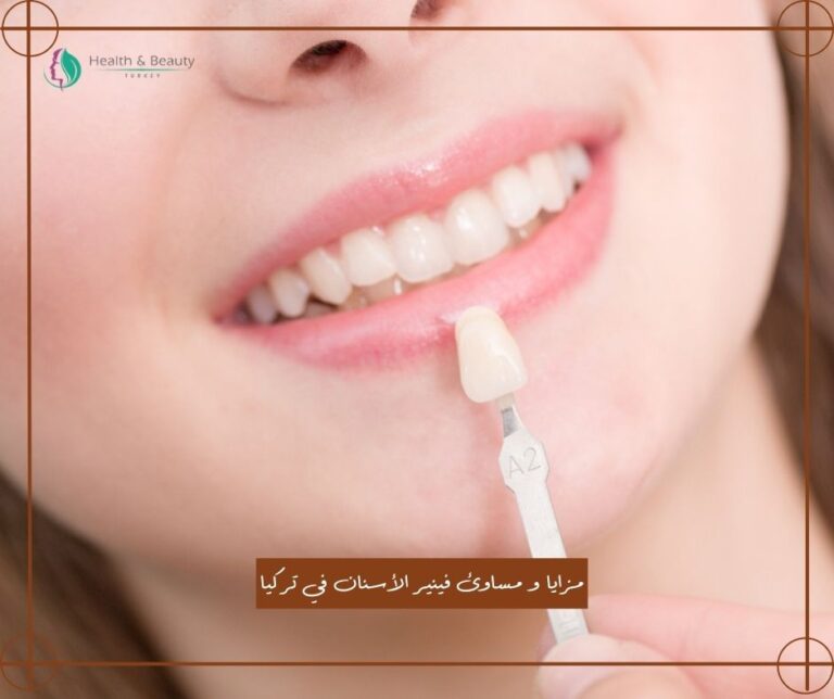 مزايا و مساوئ فينير الأسنان
