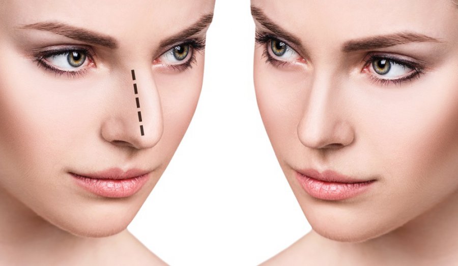 ما هي عملية تجميل الأنف في تركيا؟ 1 ما هي عملية تجميل الأنف في تركيا؟