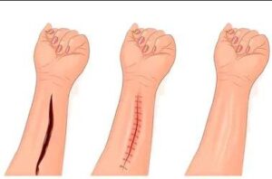 خياطة الجروح التجميلية في تركيا