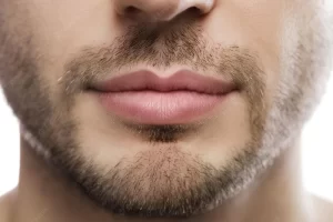 علاج تصغير الشفايف للرجال جراحياً في تركيا