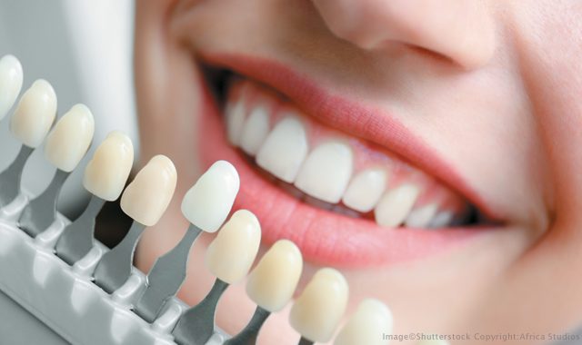 أفضل 6 تقنيات لتجميل الأسنان 