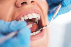 كيف يتم علاج قناة الجذر؟