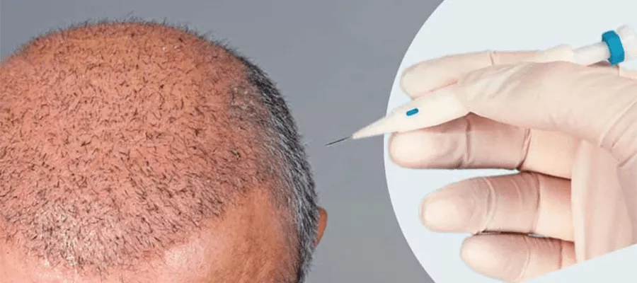 زراعة الشعر بتقنية أقلام تشوى وفق المراحل 1 زراعة الشعر بتقنية أقلام تشوى DHI