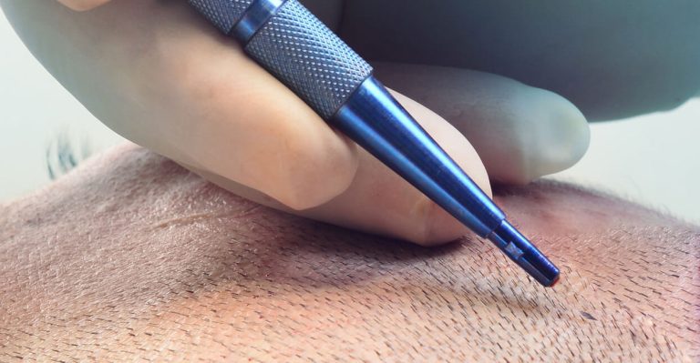 زراعة الشعر بتقنية السفير 2022