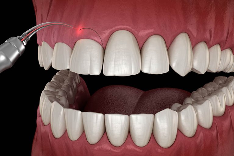 عملية قص اللثة وتجميلها 2022