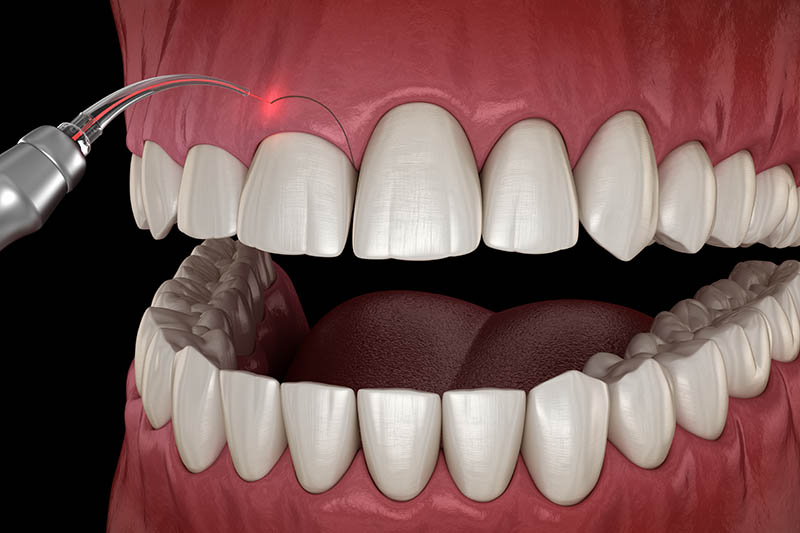 عملية قص اللثة وتجميلها 2022 1 عملية قص اللثة وتجميلها 2022