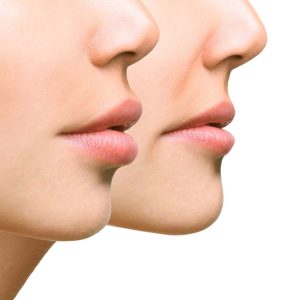  عملية تصغير الشفاه (تصغير الشفايف) 2022