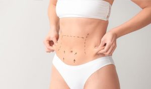 عملية تجميل سرة البطن
