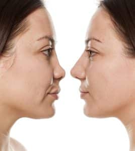 معلومات خاطئة عن عملية تجميل الانف