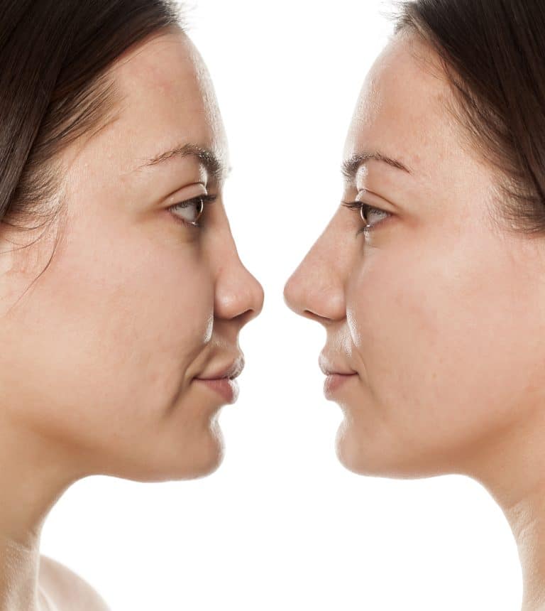 معلومات خاطئة عن عملية تجميل الانف