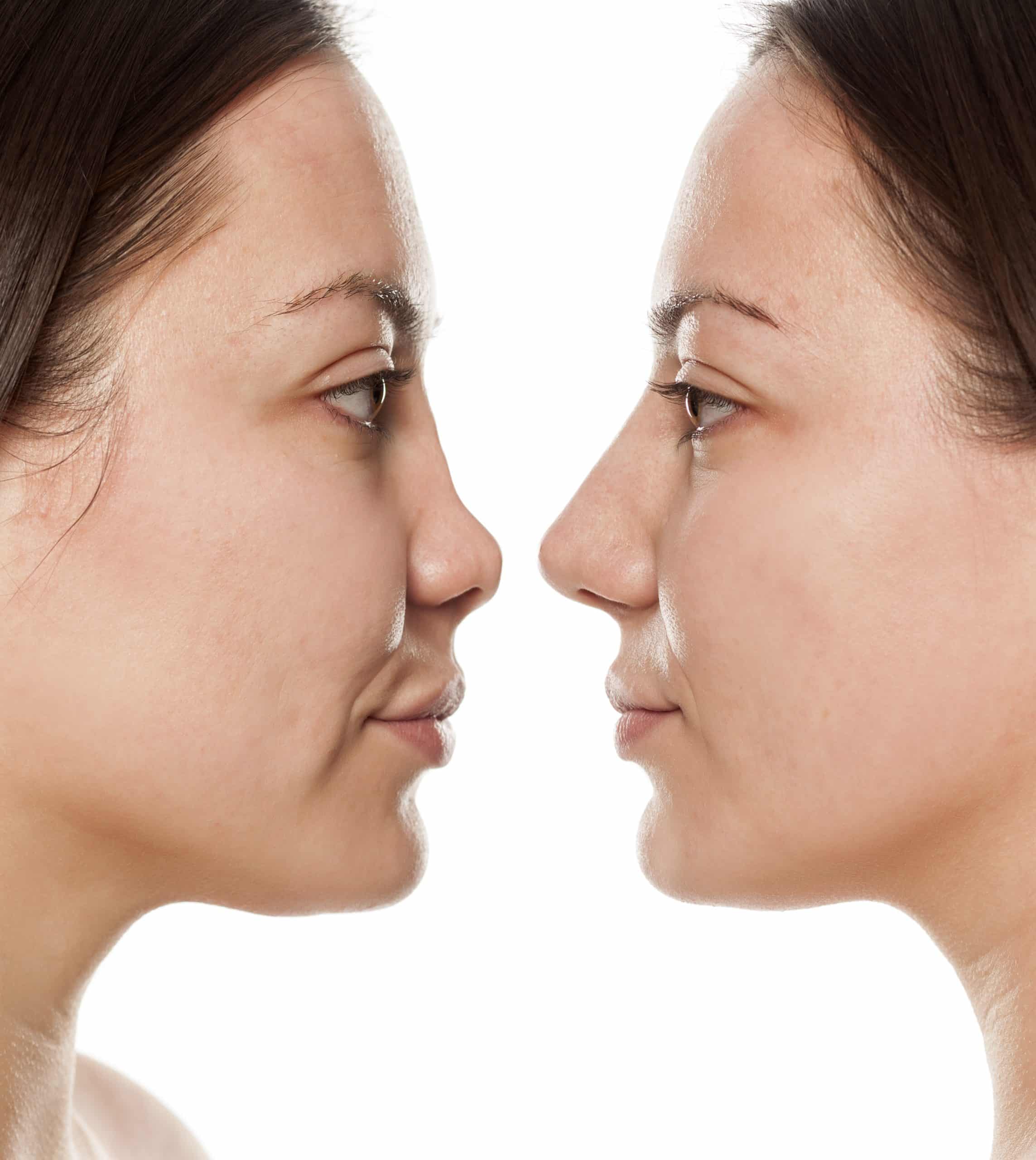 معلومات خاطئة عن عملية تجميل الانف 1 معلومات خاطئة عن عملية تجميل الانف