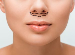 عملية رفع الشفة العلوية