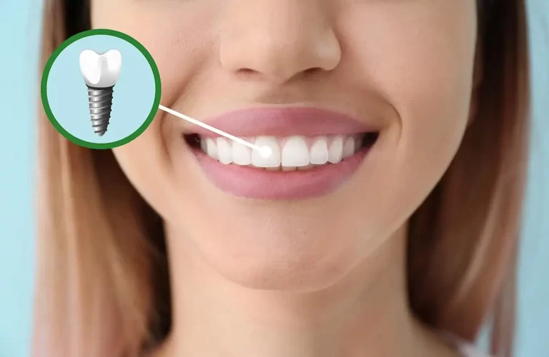 عملية زراعة الأسنان الفورية 1 عملية زراعة الأسنان الفورية