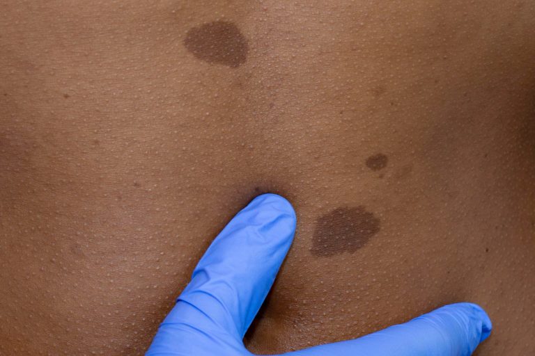 تجميل و إزالة الوحمات 1 تجميل و إزالة الوحمات