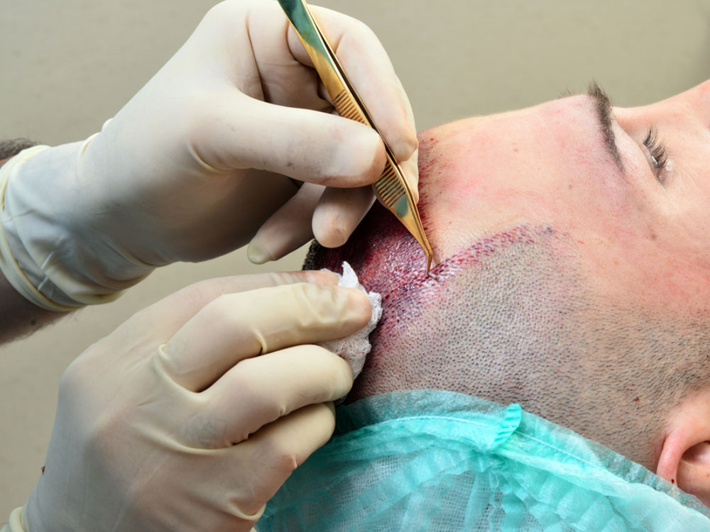 Facts about Hair Transplant Procedures - Health & Beauty Turkey