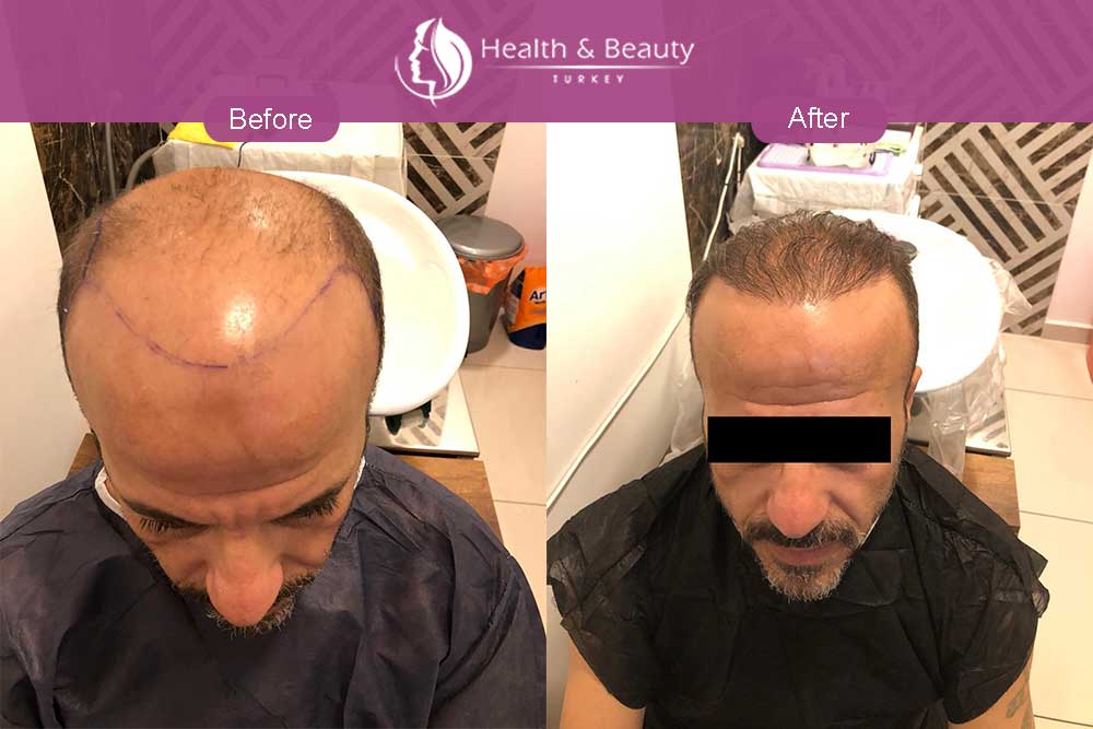 Who can get a hair transplant? - Health & Beauty Turkey