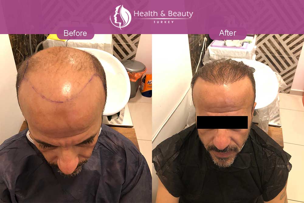 Hair Transplant Repair Turkey - EsteNove Hair Transplant