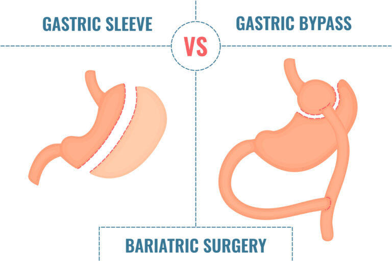 Gastric Sleeve Gastric Bypass
