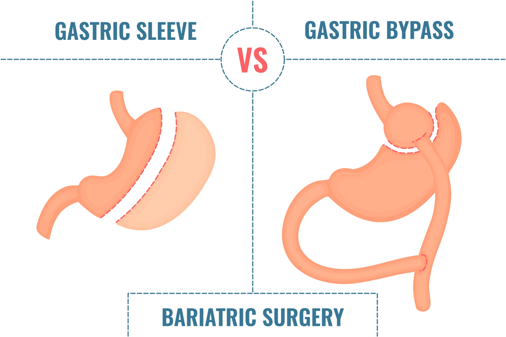 Gastric Sleeve Gastric Bypass 