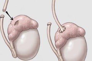 Vasectomy reversal surgery