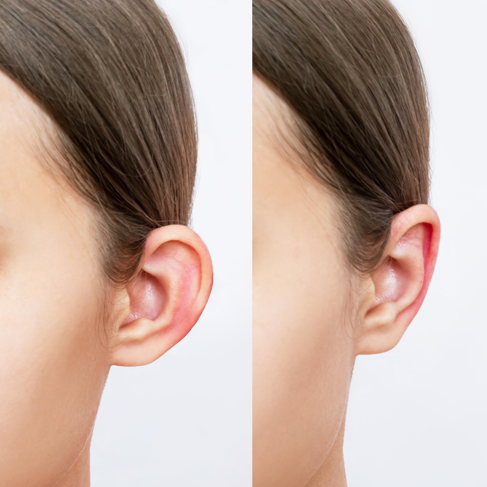 Otoplasty (Ear Reshaping)