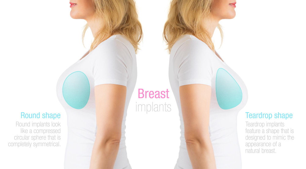 What is a breast augmentation?