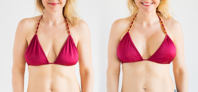 What is a breast augmentation?