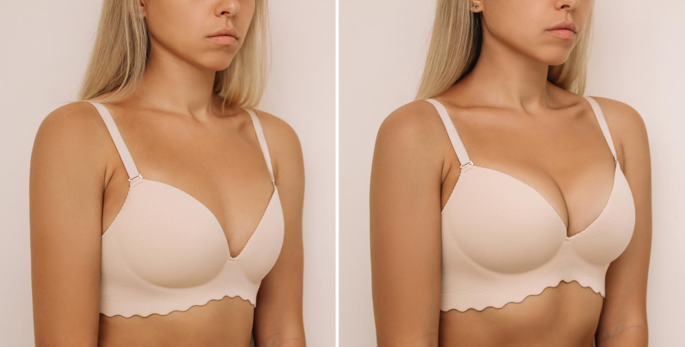 What is Breast implants Surgery?