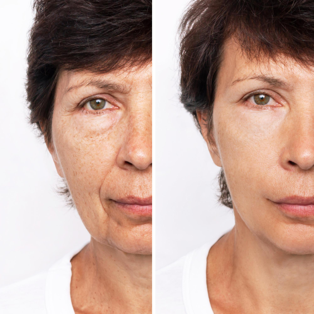 What is Mini Facelift Surgery?