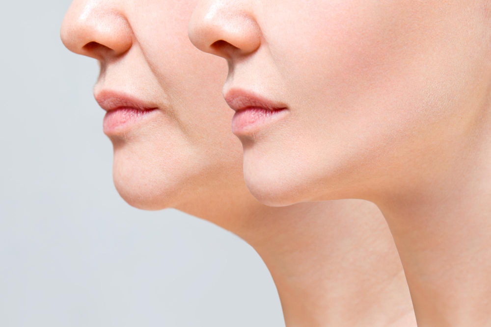 Chin Augmentation