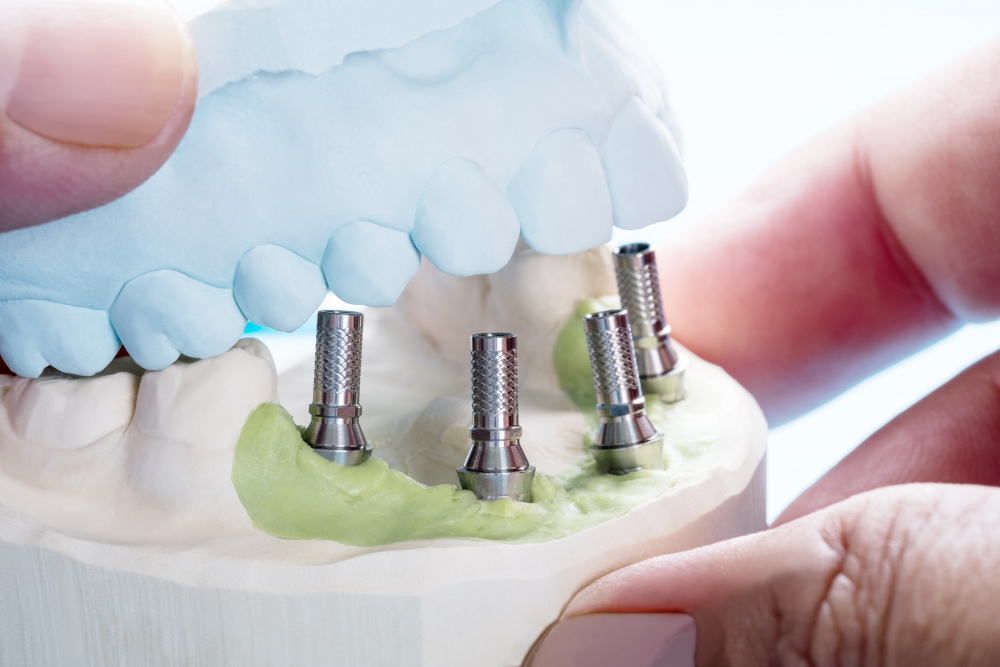 Dental Implants The Complete Guide