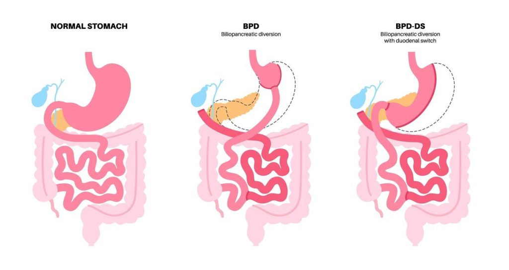 Biliopancreatic Diversion with Duodenal Switch (BPD/DS)