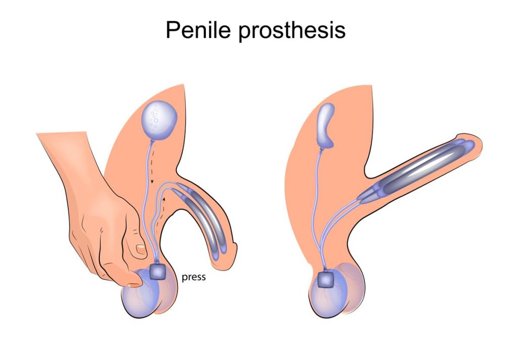 Penile Implants