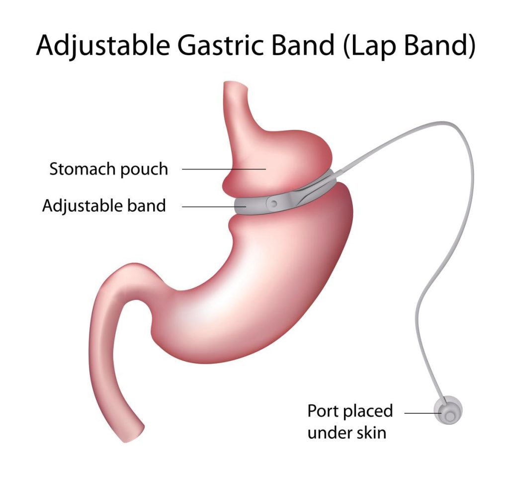 What is Laparoscopic adjustable gastric banding (LAGB)?