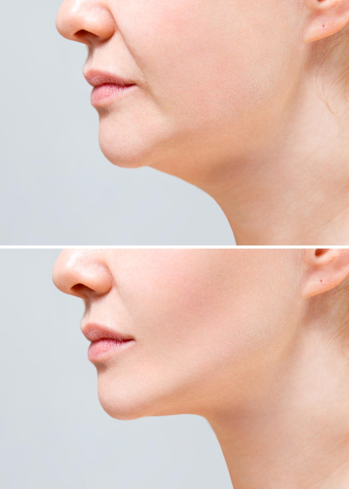 Chin Augmentation