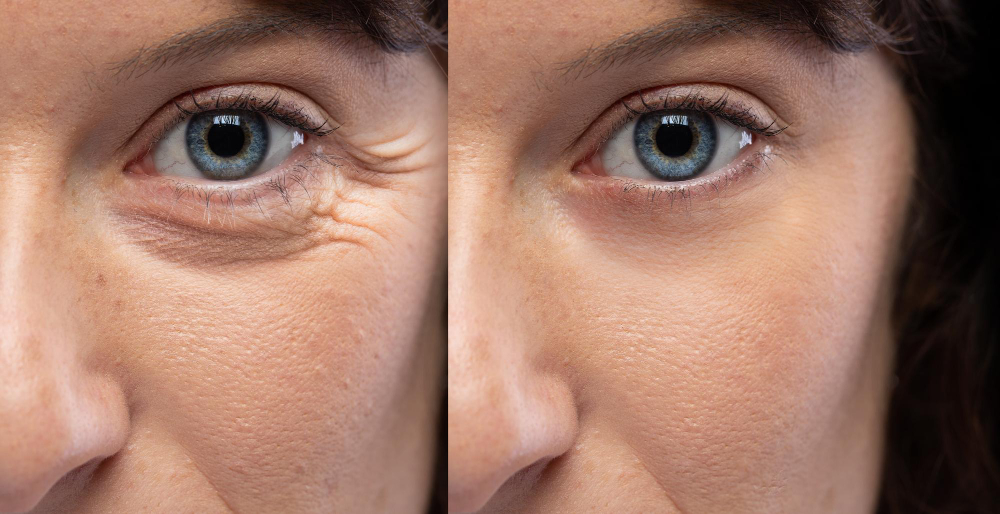 Blepharoplasty