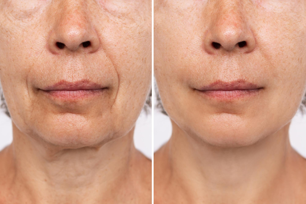 What is Mini Facelift Surgery?