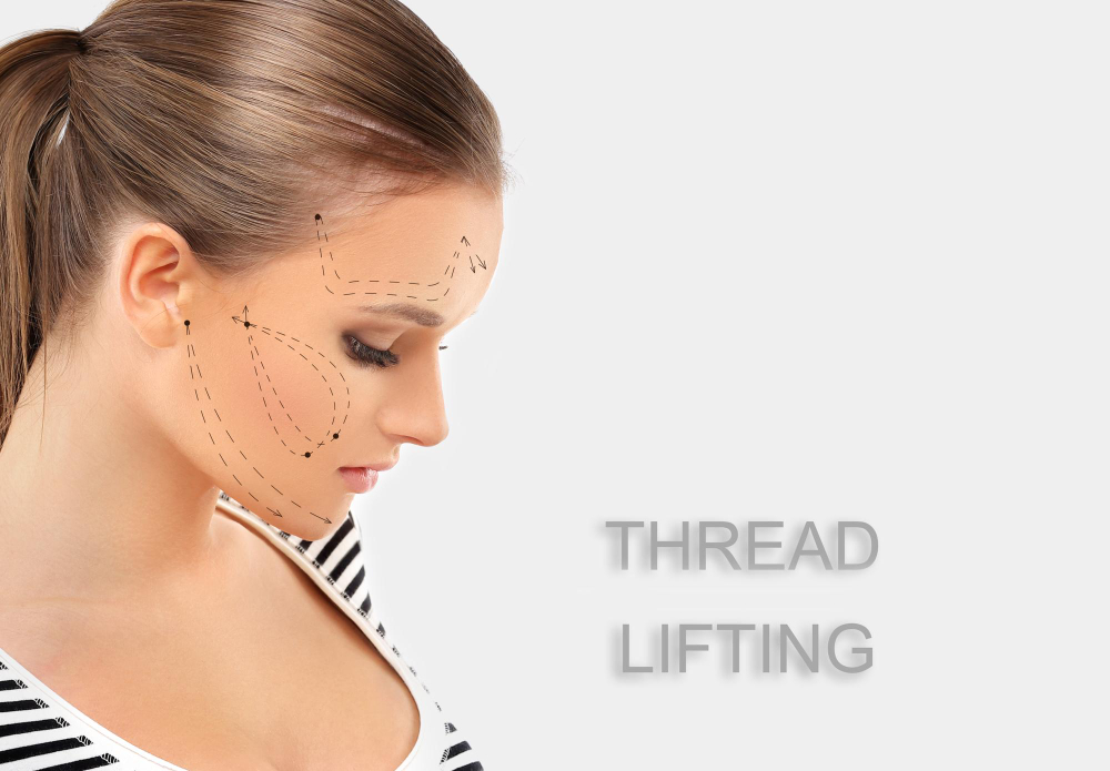 Thread Lift